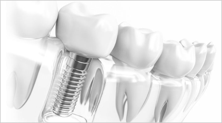 インプラント